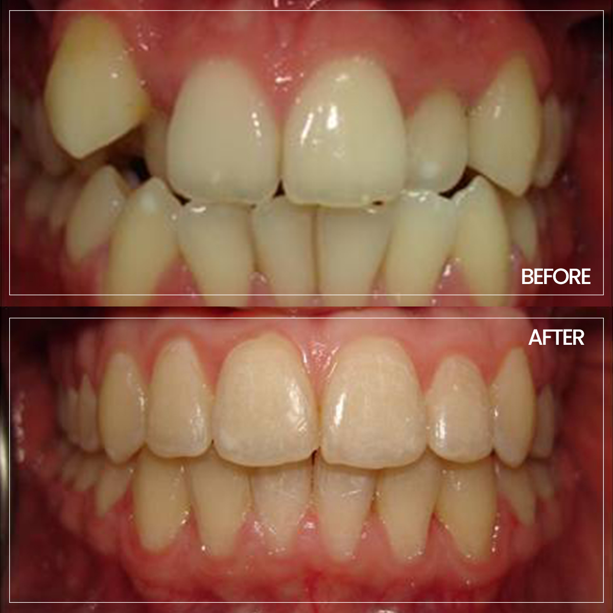 ortodonti before-after-2