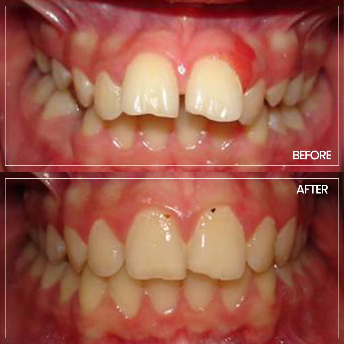 ortodonti before-after-3