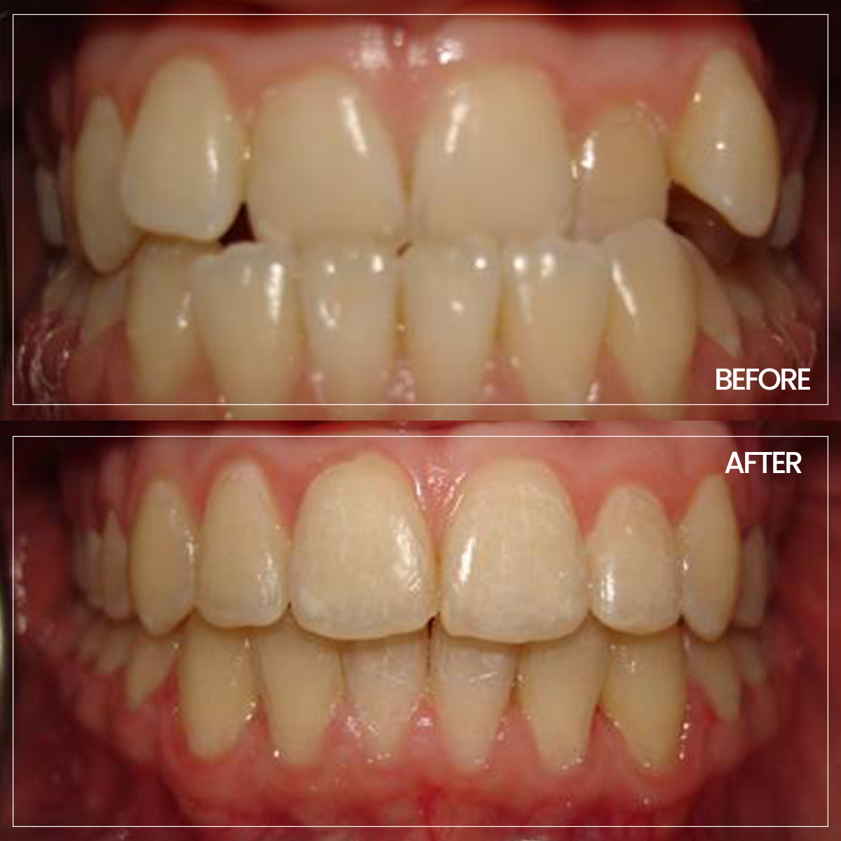 ortodonti before-after-4