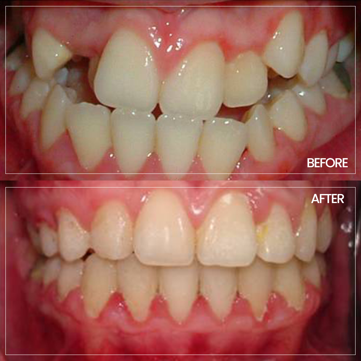 ortodonti before-after-5