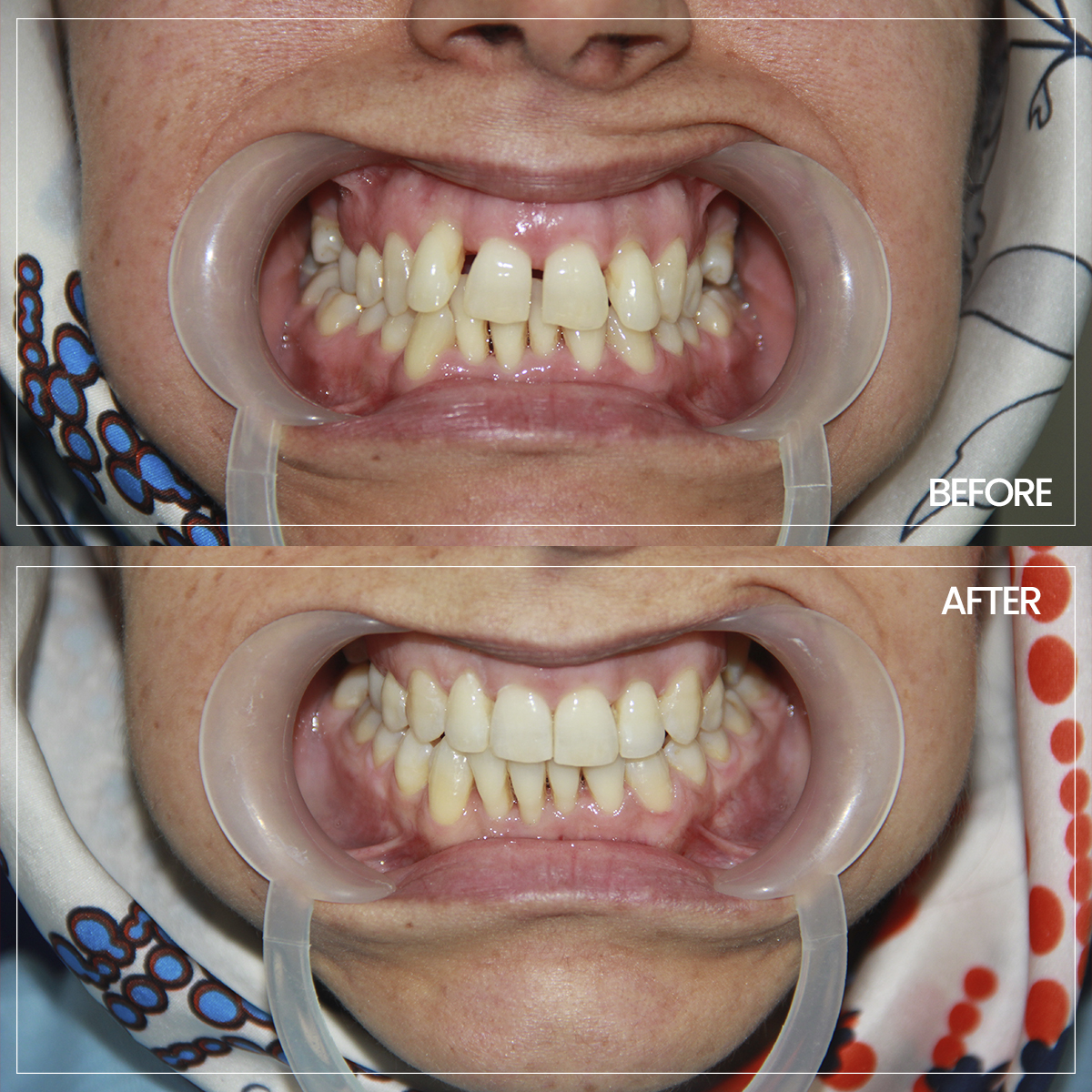 ortodonti before-after-7